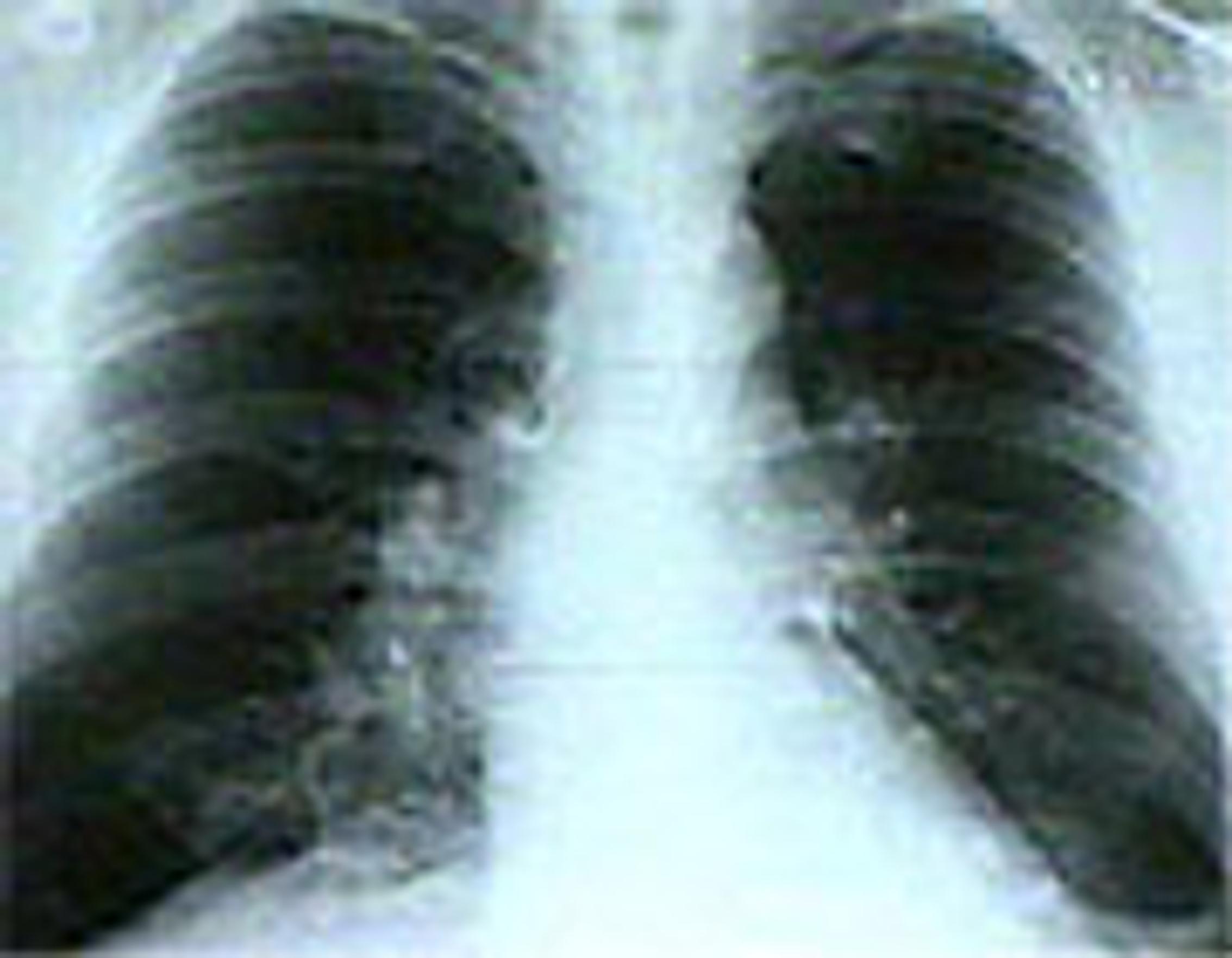 Savuttomien keuhkosyöpä eroaa tupakoitsijoiden syövästä