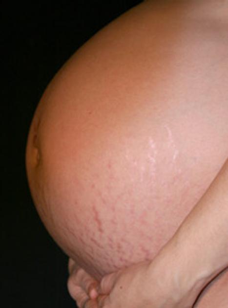 растяжки на груди во время беременности фото фото 6