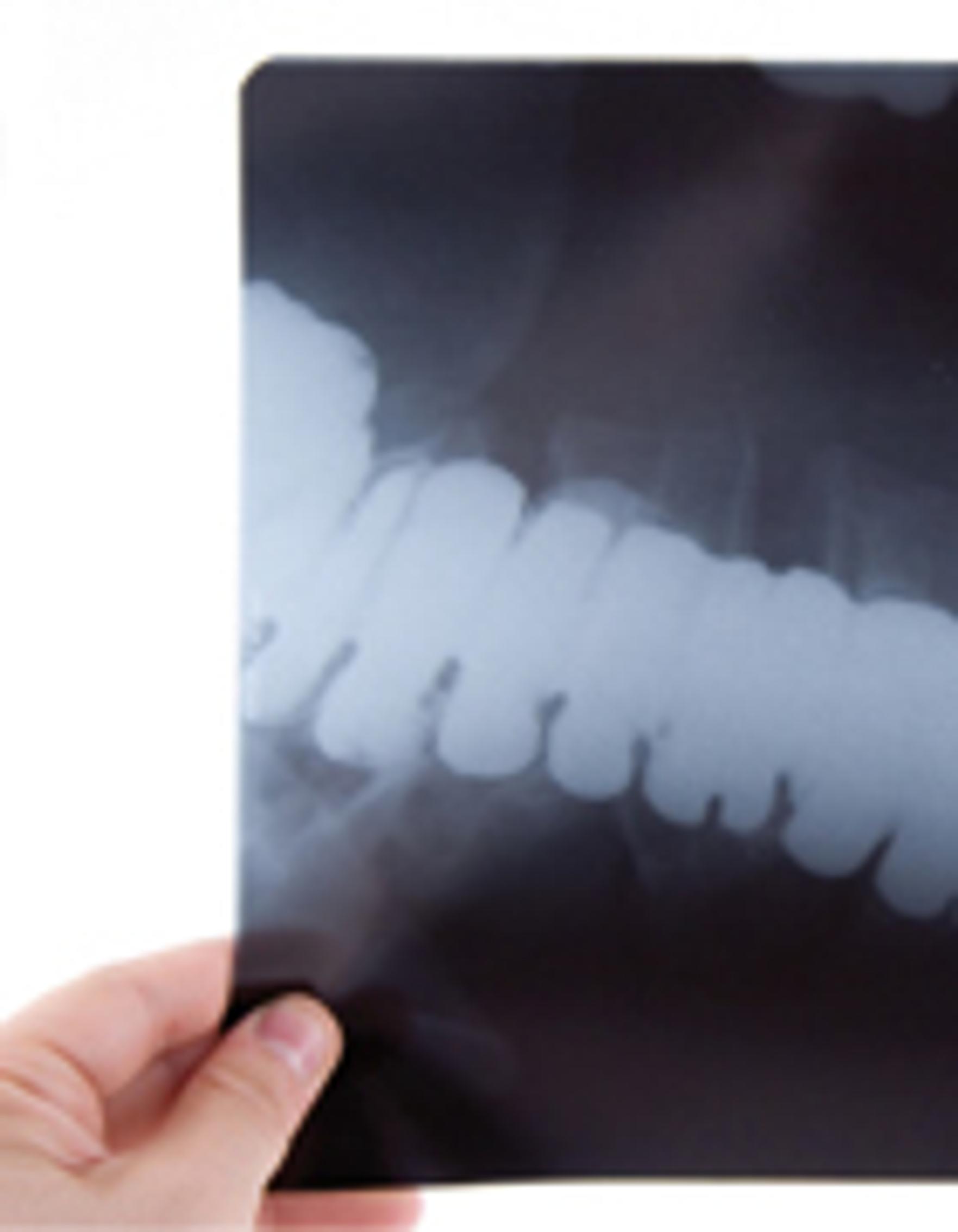 Liika rasvahapon saanti voi olla terveysriski Terve.fi