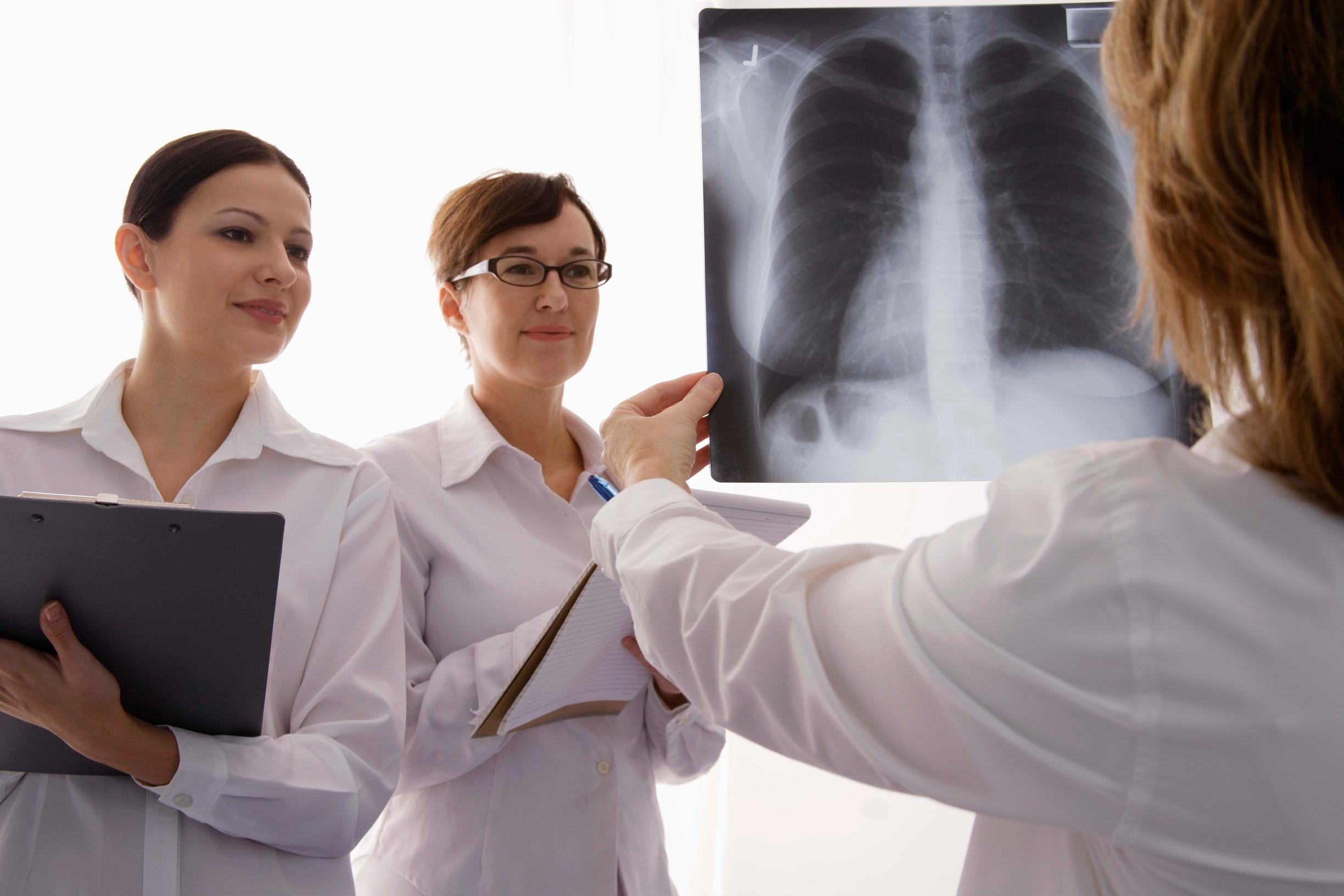 Keuhkosyövän röntgenseulonnat eivät säästä henkiä