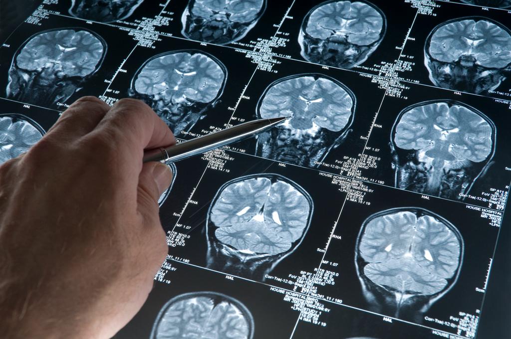 Parkinsonin tauti | Terve.fi