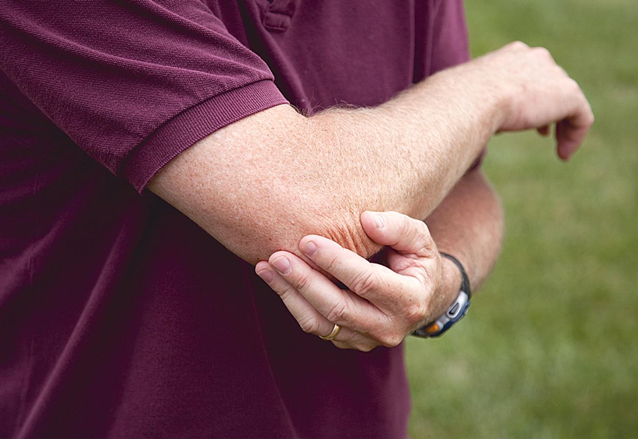 Медиальный эпикондилит локтевого сустава симптомы. Боли в локтевом суставе что это. Боли в локтевом суставе что это. Эпикондилит локтевого сустава. Эпикондилит локтевого сустава.