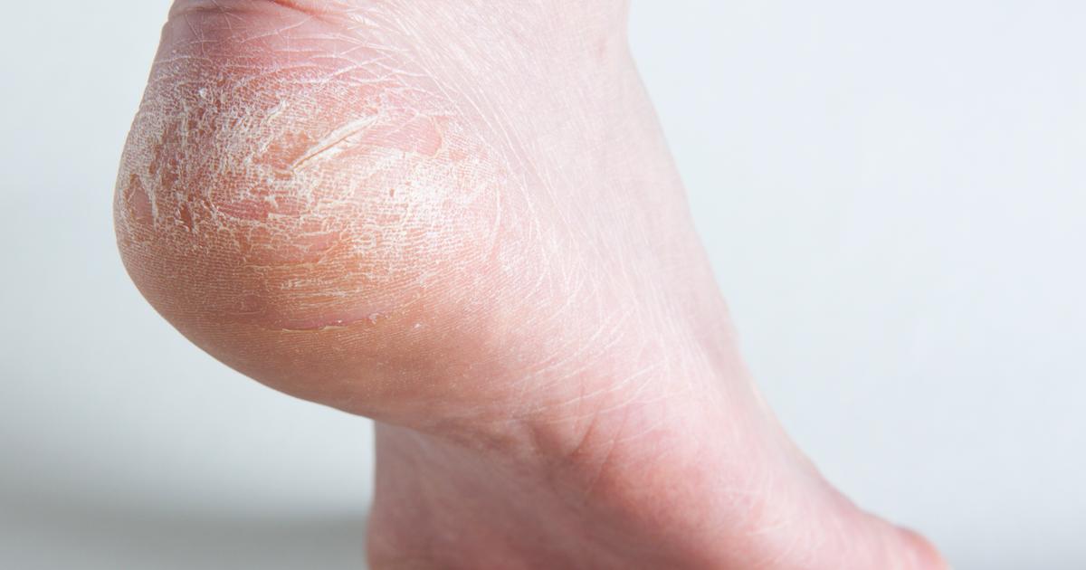 Как выглядит экзема на ногах фото Как выглядит экзема на ногах фото