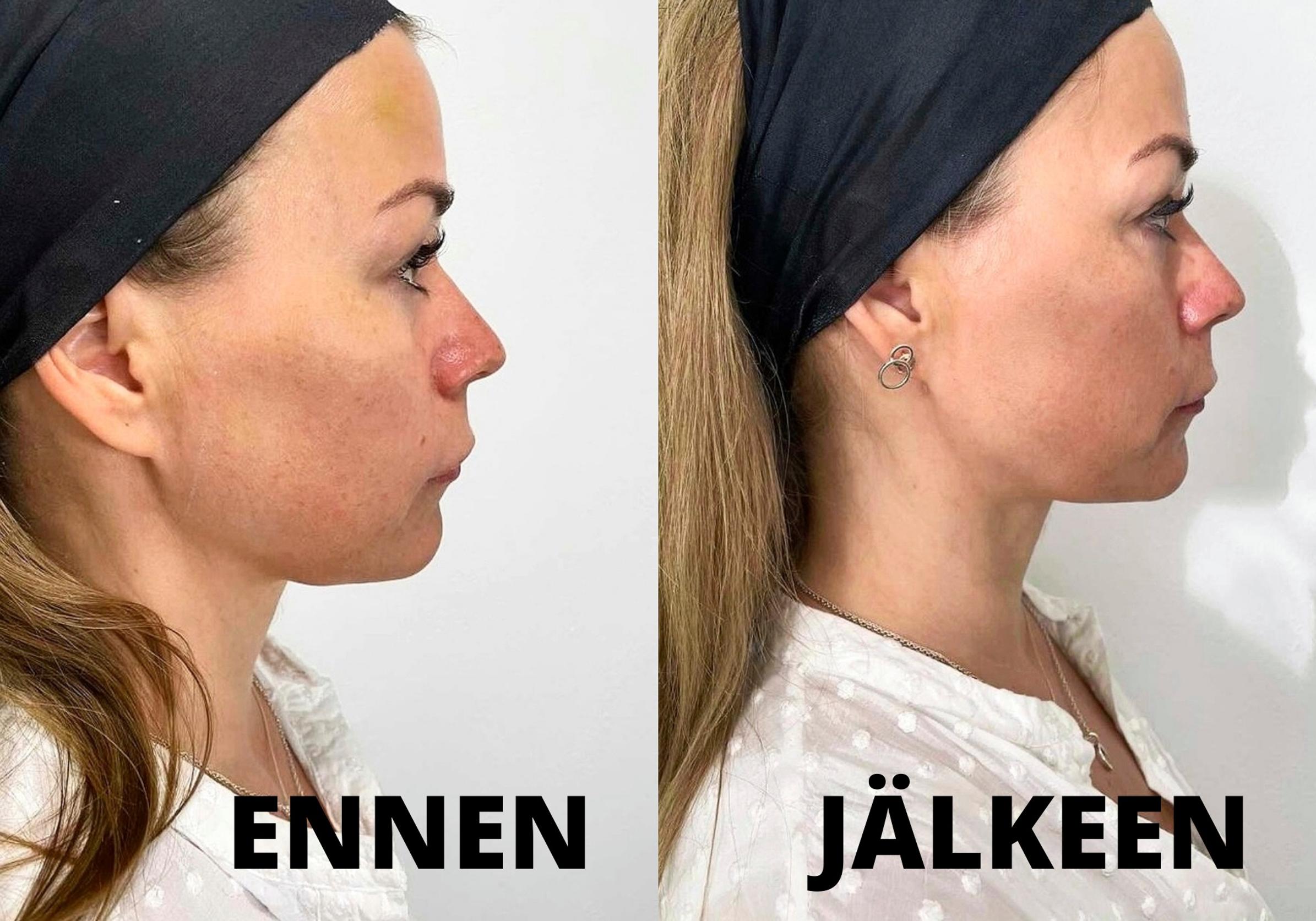 ”Leukalinjani on entistä suorempi, kasvojen muoto ovaalimpi ja poskipäät hivenen pyöreämmät.”