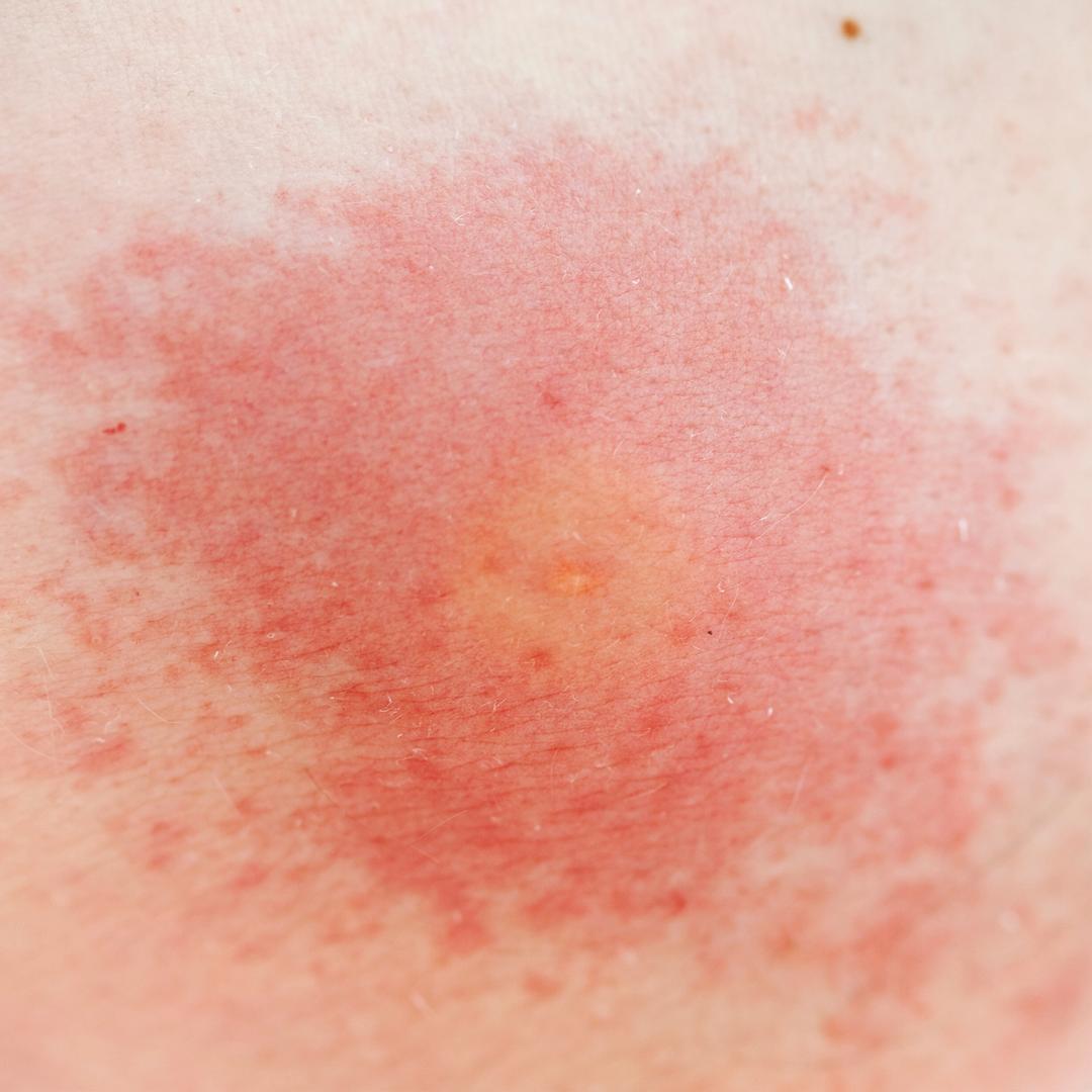 Uusi l ke auttaa psoriasikseen eritt in tehokkaasti terve fi