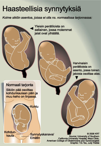 Infografiikka - Haasteellisia synnytyksiä 