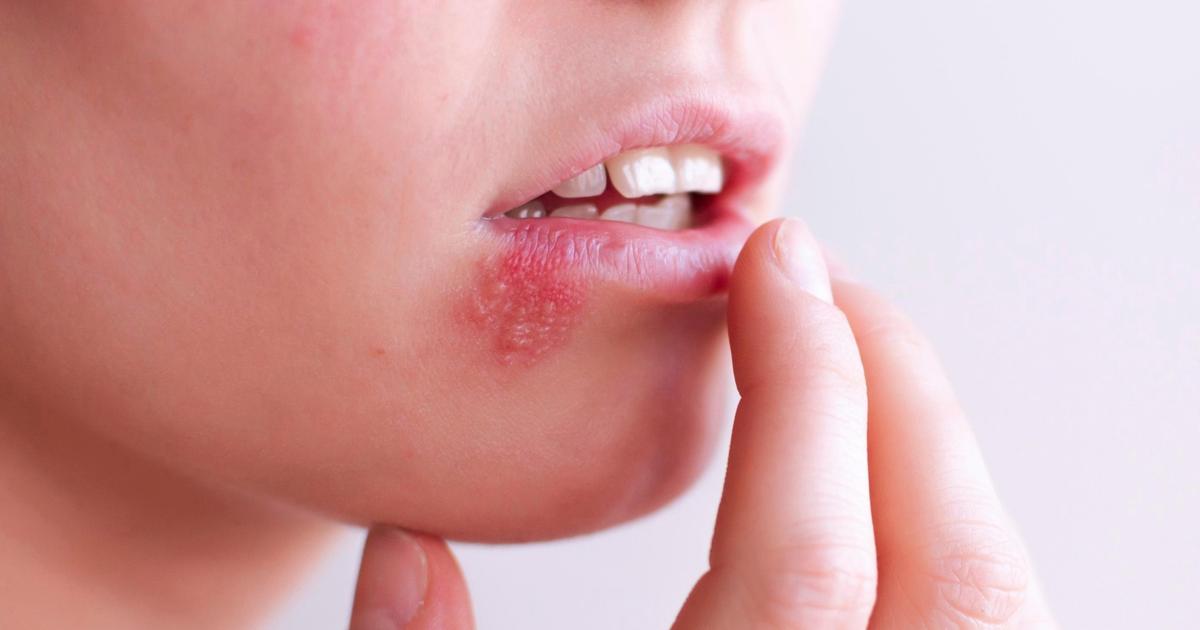 Huuliherpes On Tykytt v Stressipommi Terve fi huuliherpes-on-tykytt-v-stressipommi-terve-fi